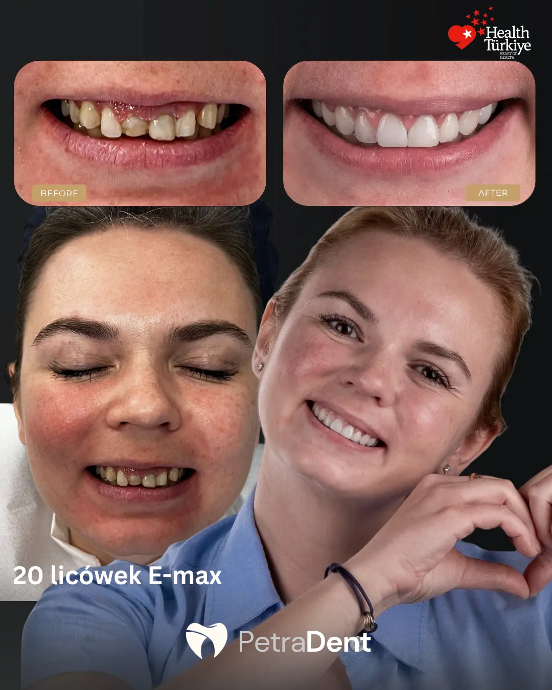 petradent-20-licowek-e-max